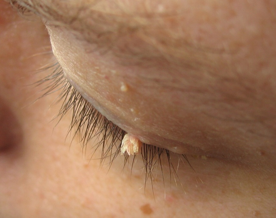 A thin, finger like filiform wart on the edge of an upper eyelid