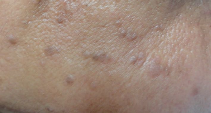 A group of small, smooth, slightly raised flat warts on the skin of the chin